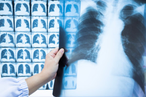 Cáncer de Pulmón. Unidad contra el Cáncer de Pulmón en la recta final.