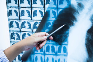 Tuberculosis treatment pilot extended until mid-2026. Cost this year: over PLN 60 million