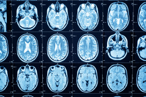 This is how salt affects the brain. New research changes existing knowledge.